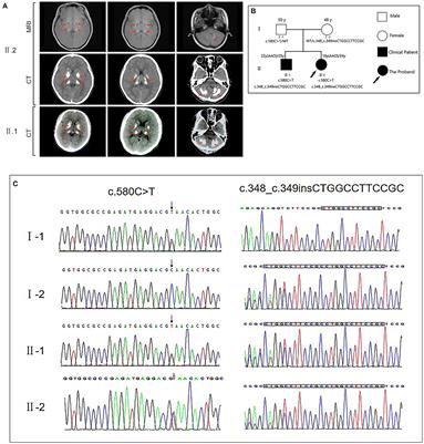 A novel MYORG mutation causes primary familial brain calcification with migraine: Case report and literature review